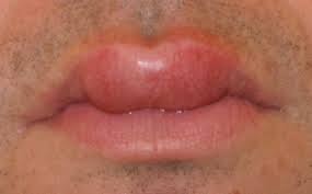 What medications could cause a swollen upper lip?